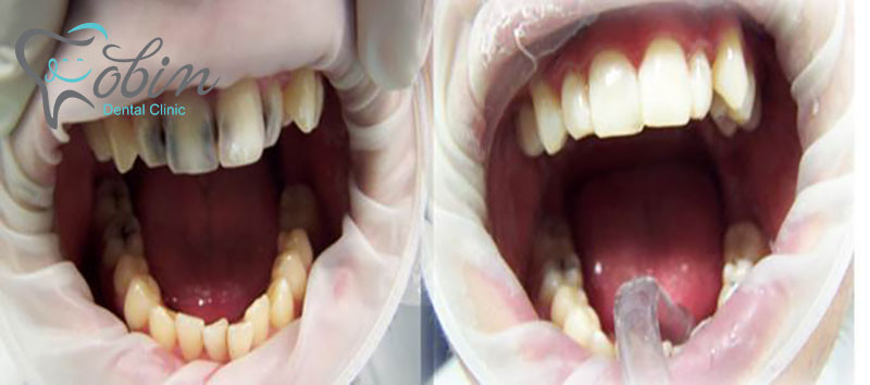 ترمیم دندان باعث ایجاد زیبایی در دندان ها می شود